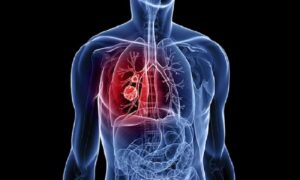 Most lung cancer patients in India are non-smokers